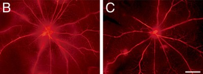 FOTO RETINOPATIA