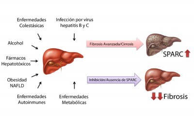 infografia CIRROSIS HEPATICA