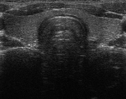 Cuestionan la utilidad de la ecografía para predecir la malignidad de ciertos nódulos tiroideos
