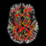 El método liderado por investigadores del Instituto de Neurociencia Cognitiva y Traslacional reduce a la mitad el tiempo de procesamiento de imágenes del cerebro obtenidas con resonancia magnética.