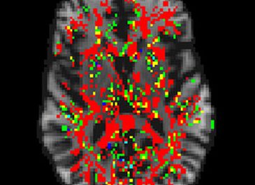 Resonancias del cerebro más rápidas