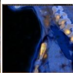 Por primera vez, especialistas del CEMIC lograron resolver 11 casos clínicos dudosos de hiperparatiroidismo mediante un tipo de tomografía, llamada “de emisión de positrones” o PET.