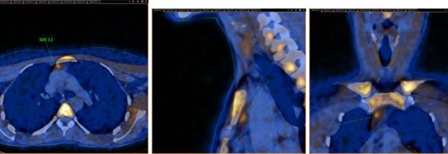 Médicos argentinos proponen método nuclear para confirmar el diagnóstico de hiperparatiroidismo