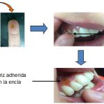 Aplicación de una matriz polimérica para el tratamiento de patologías bucales desarrollada por los científicos de Rosario. 