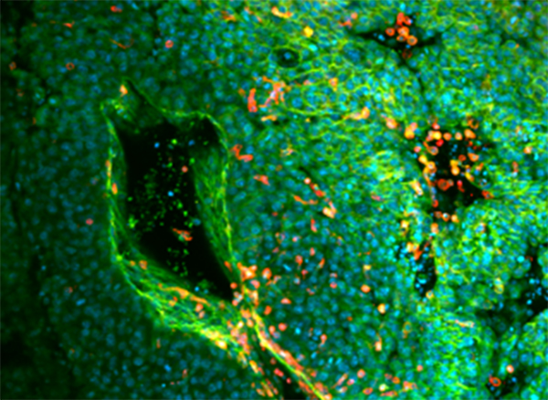 Proteína de bacteria que causa la brucelosis podría mejorar la inmunoterapia contra el melanoma