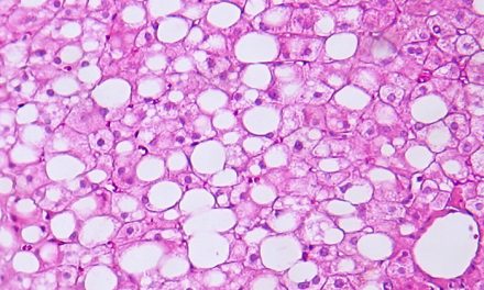 Enfermedad del hígado graso no alcohólico: hallan relación entre genes del paciente y las bacterias que colonizan el hígado