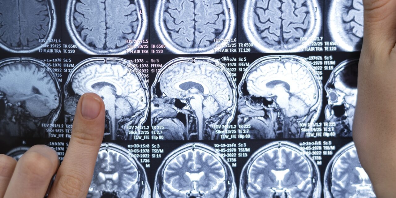 Esclerosis múltiple: identifican proteínas novedosas implicadas en la neurodegeneración